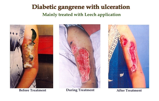 diabetic gangrene with ulceration