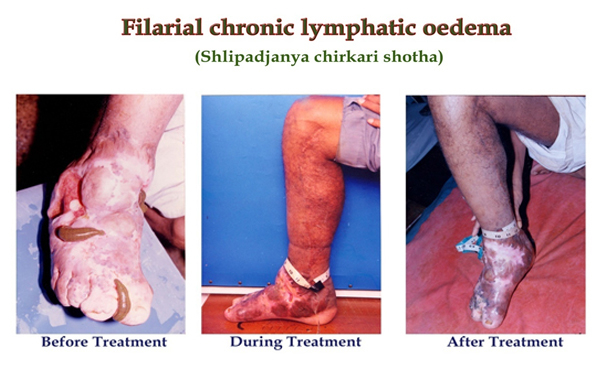 Filarial chronic lymphatic oedema
